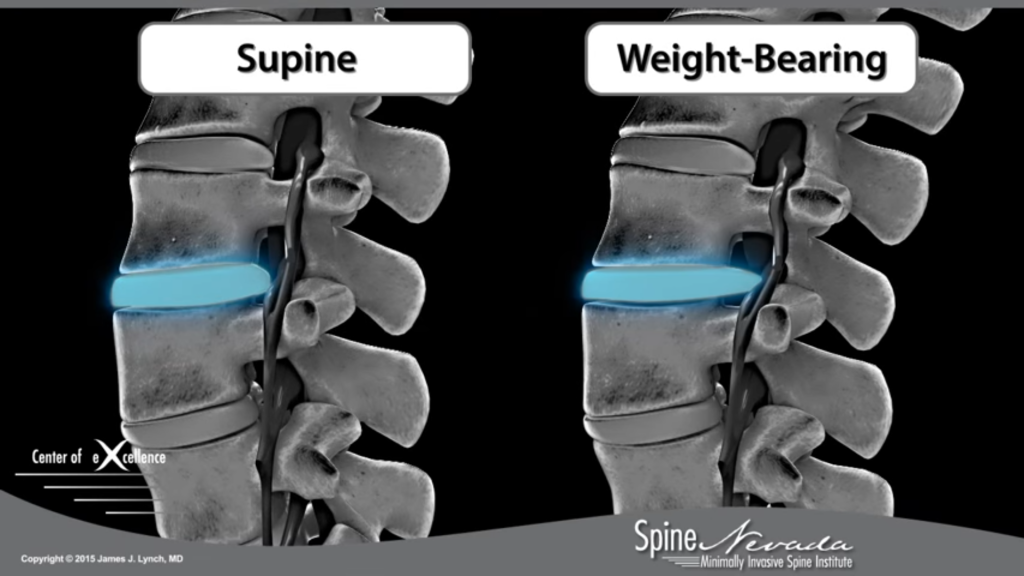 生昇復健 椎間盤突出？分類及觀念釐清