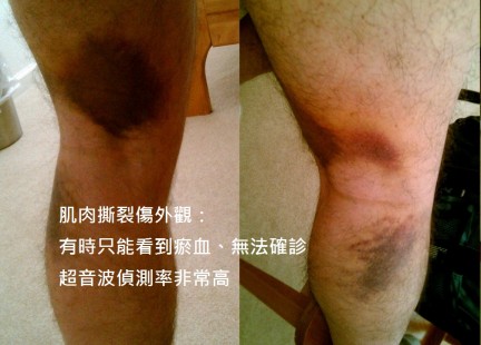 2010-10-02_pulled_hamstring