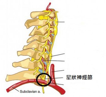 Stellate-Ganglion-Block-1