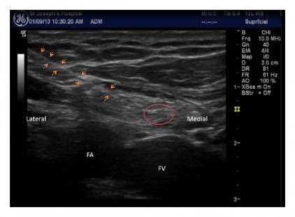 Injection-into-the-inguinal-canal-to-block-the-genitofemoral-nerve