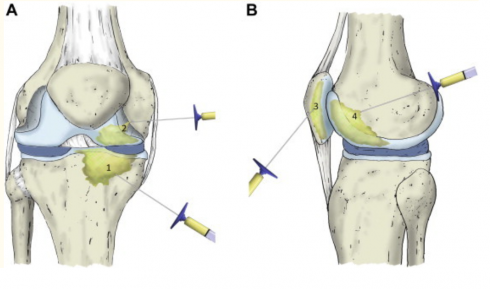 BONE INJECTION