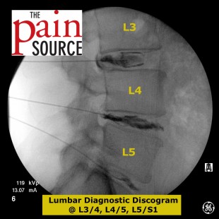 Lumbar-Discogram-Lateral-view.-After-contrast-The-Pain-Source