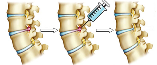 stem_cell_for_lumbar_disc