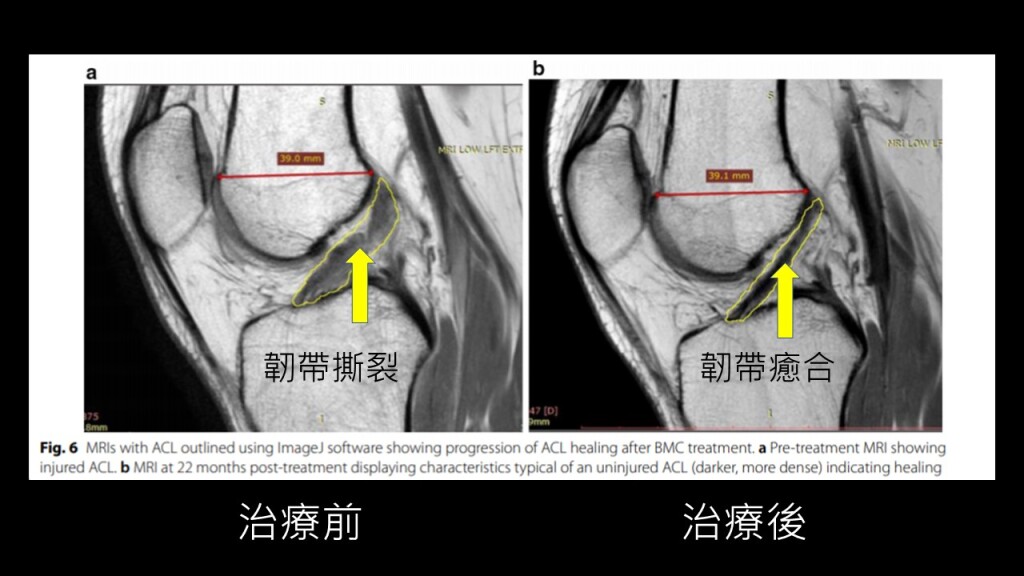 acl3