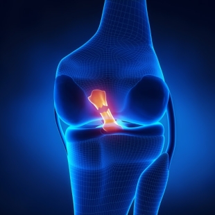 前十字韌帶創傷 Anterior Cruciate Ligament Injury (ACL injury)_膝痛成因物理治療